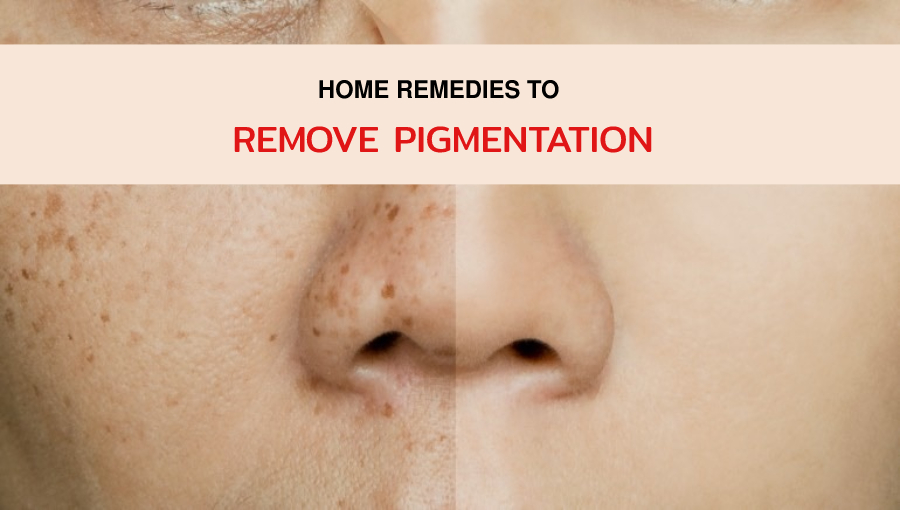 Unbelievable Home Remedies to Remove Pigmentation